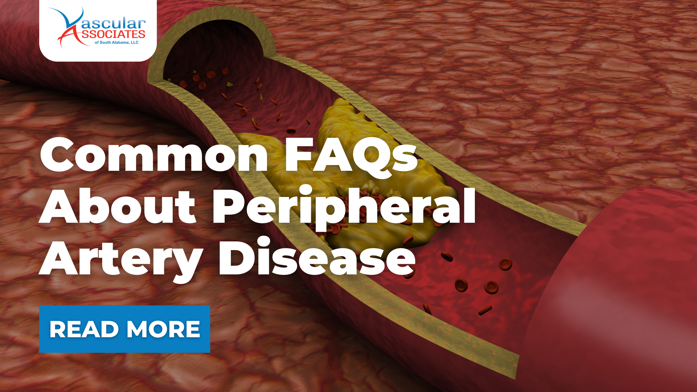 Vascular Associates Blog | Common FAQs About Peripheral Artery Di