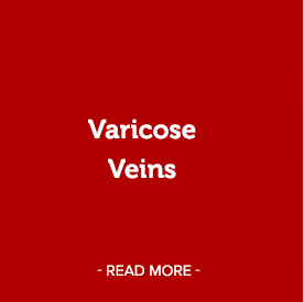 Varicose Veins